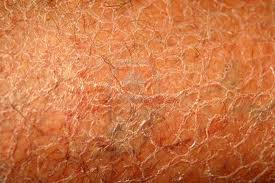 La ménopause : sécheresse de la peau et des muqueuses – Miss Frottis